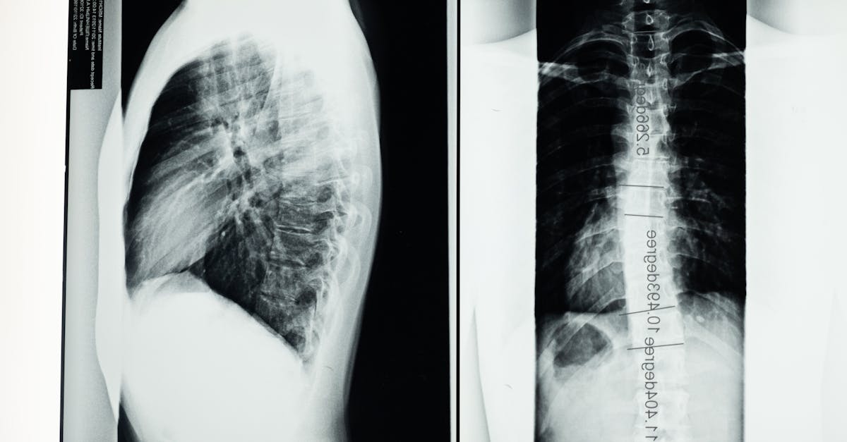 discover essential information about scoliosis, including its causes, symptoms, diagnosis, and treatment options. learn how to manage this condition and improve your posture for a healthier life.